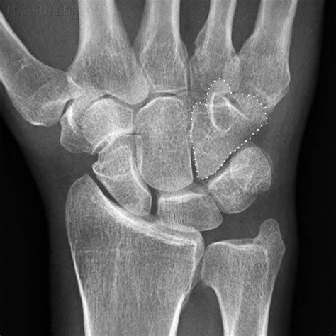 Baseball Wrist Injuries – Christian Walker’s Broken Wrist