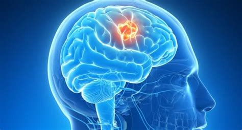 What Is A Brain Tumor Malignant Brain Tumor Trendingtop5