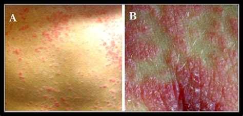 Photographs Showing Papule And Plaque Forms Of Guttate Psoriasis A