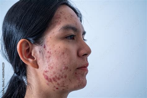 Acne On Face Because The Disorders Of Sebaceous Glands Productions