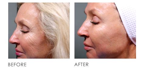 Ultherapy Before After Premier Clinic Cn
