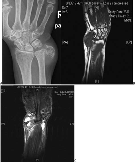 Soft Tissue Chondroma Over The Ulnar Side Of The Wrist A X Ray Shows