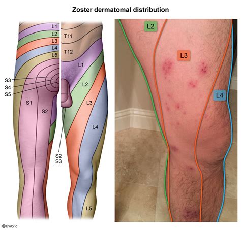 How To Identify Herpes Zoster Dermatome Map Sexiz Pix