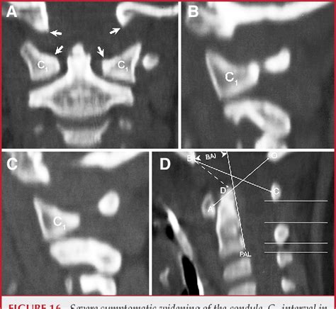 Figure 1 From Atlanto‐occipital Dislocation—part 2 The Clinical Use Of