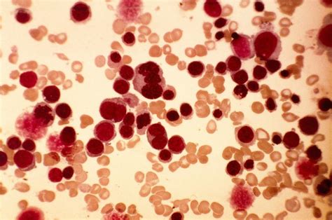 Acute Erythroid Leukaemia Micrograph Photograph By Science Photo