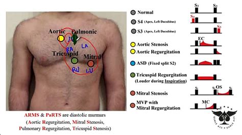227 Heart Murmurs S3 S4 Aortic Tricuspid Regurgitation Stenosis