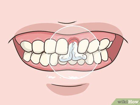 The following factors are often responsible for looseness in one or more teeth hardened plaque, known as tartar, causes the gums to pull away from the teeth, creating gaps that. 3 Ways to Pull a Loose Tooth at Home - wikiHow