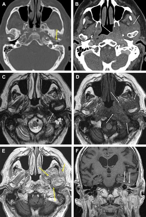 Imaging Of Inflammatory And Infectious Diseases In The Temporal Bone