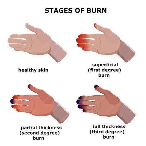 Premium Vector Medical Vector Illustration Burn Stages Degree Burns