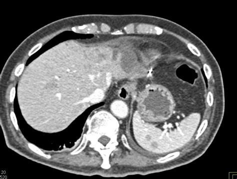 Metastatic Renal Cell Carcinoma To Liver And Lungs And Spleen Kidney