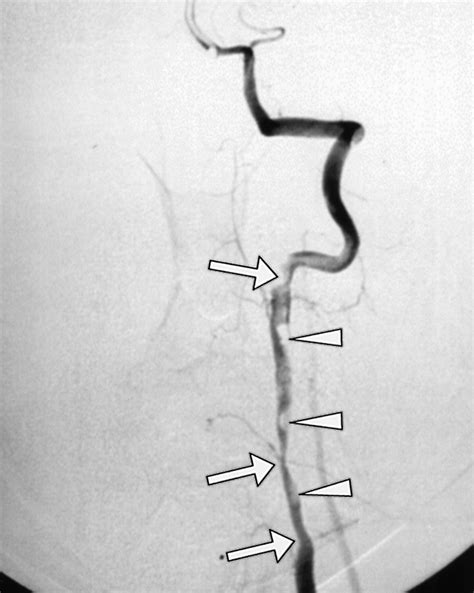 Vertebral Artery Dissection Spectrum Of Imaging Findi Vrogue Co