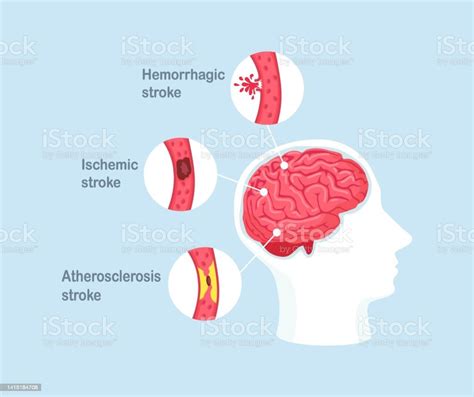 Types Of Human Brain Stroke Ischemic Atherosclerosis And Hemorrhagic