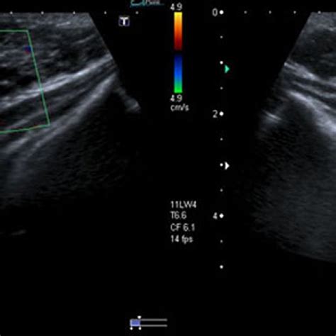 Ultrasound Images Of The Subareolar Areas Of Bilateral Breasts