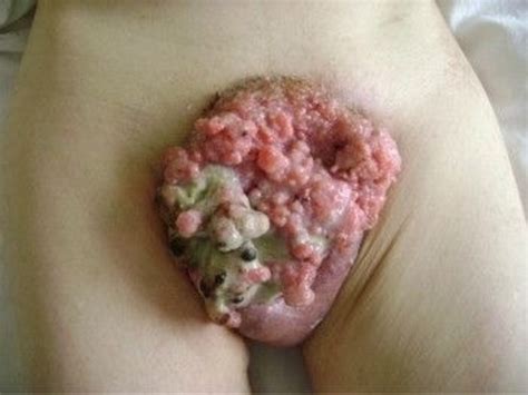 Basal Cell Carcinoma Skin Cancer Stages Sexiezpix Web Porn