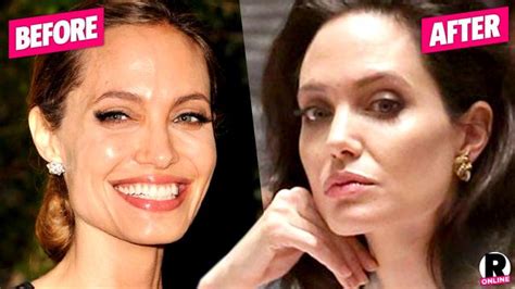 Facelift For Angie Top Doc Claims Surgeon Gave Jolie Her Tight New