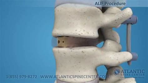 Alif Anterior Lumbar Interbody Fusion Atlantic Spine Center