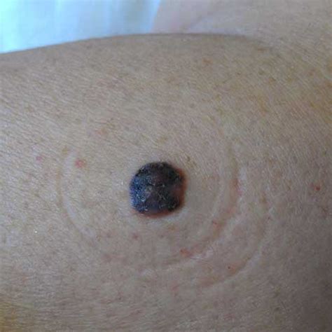 I used burning method describe above and got lots of black stops (burned angiomas). Skin Cancer | Melanoma | Signs and Symptoms - Skin cancer ...