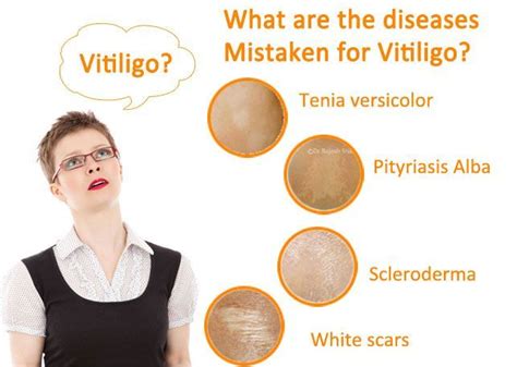 Pin On Natural Vitiligo Treatment