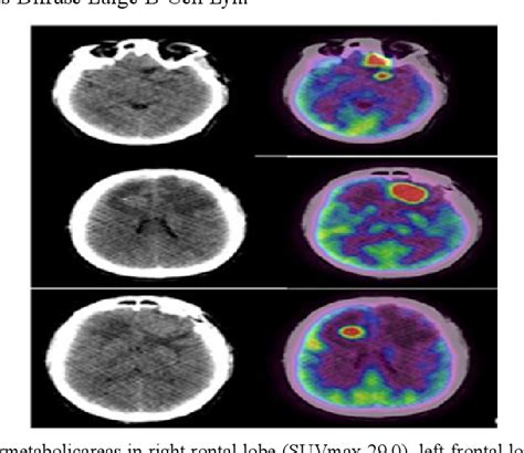 Figure 1 From Role Of 18f Fdg Pet Ct In Cns Lymphoma A Case Report