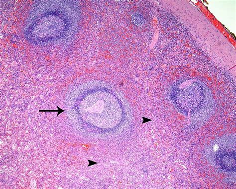 Microscopic Examination Confirmed The Splenic Tissue Histology Which