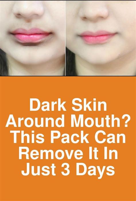 Dark Skin Around Mouth This Pack Can Remove It In Just 3 Days It Is