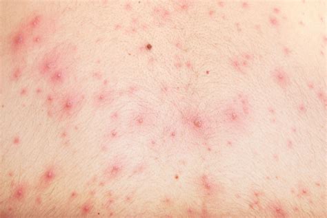 Chicken Pox Pictures In Adults