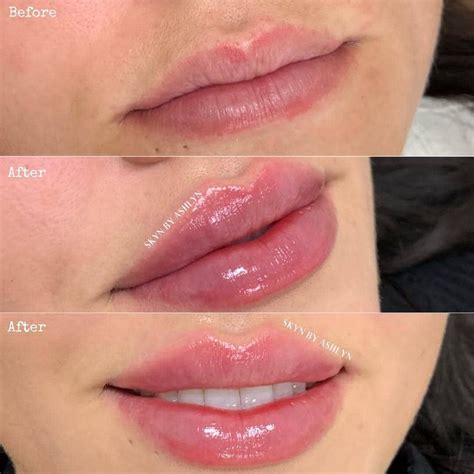 Best Of Cosmetic Dermatology On Instagram Before After Lip Filler Details Below What Do You