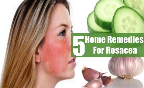 Top 5 Home Remedies For Rosacea Natural Treatments And Cures Herbal