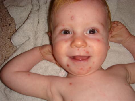 Baby Rash Pictures Causes Treatments Baby Baby Pictur
