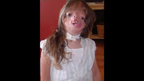 Girl Born Without A Face Juliana Wetmore Inspiring Story
