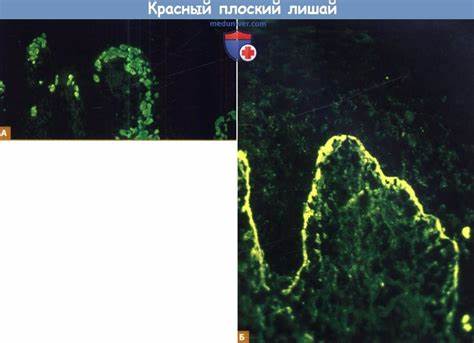 Диета при лишае красном плоском