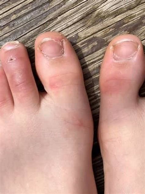 Covid Toes Coronavirus What Are Covid Toes And What Does