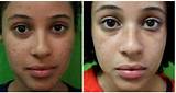 Laser Treatment For Acne Scars On Black Skin Photos