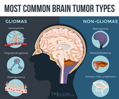 Stage 4 Brain Stem Glioma Cancer Mapasgmaes