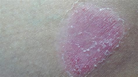 Apremilast To Be Reviewed For Mild To Moderate Plaque Psoriasis