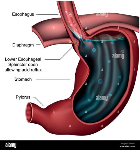 Esophagealsphincter Anatomy Reflux 3d Medical Vector Illustration Stock