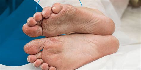 Diabetic Foot Care Routines You Should Adopt Mtvk