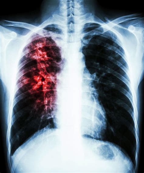 Tuberculosis X Ray Chest Xray Image Pa View Show Pulmonary Tuberculosis Stock