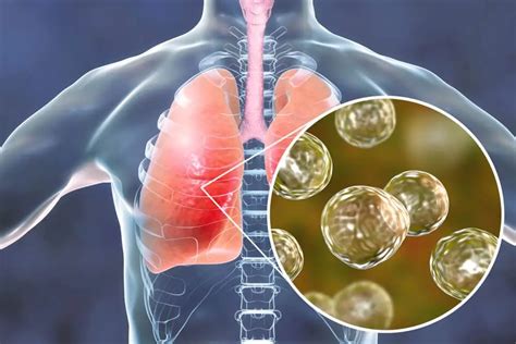 Fungal Pneumonia Symptoms And Treatment Health 2023