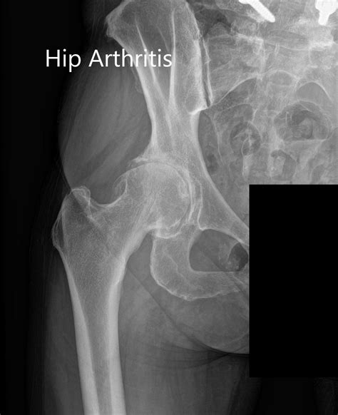 Osteophytes Hip