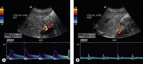 Vascular Ultrasound Of Abdominal Aortic Branches Radiology Key