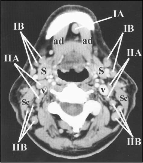 Figure 3 From Imaging Based Nodal Classification For Evaluation Of Neck