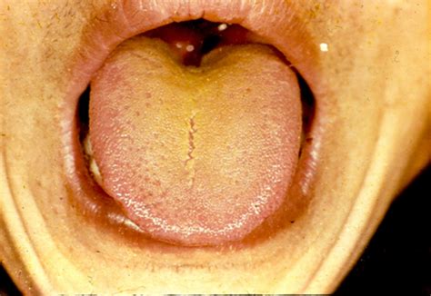 Tongue Diagnosis Pictures Flashcards Quizlet