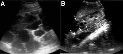 Imaging Approaches To Patients With Polycystic Kidney Disease