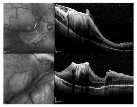 Proliferative Vitreoretinopathy Pvr Structural Cross Sectional Oct