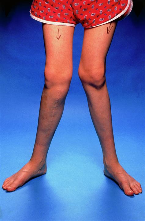 Boy With Knock Knees Genu Valgum Photograph By Medical Photo Nhs