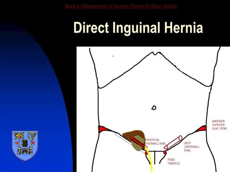 Understanding Hernia Hernia Inguinal Bladder Abdomina Vrogue Co
