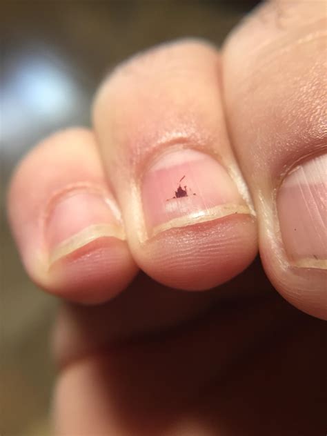 My Blood Blister Under My Fingernail Looks Like Disneylands Castle