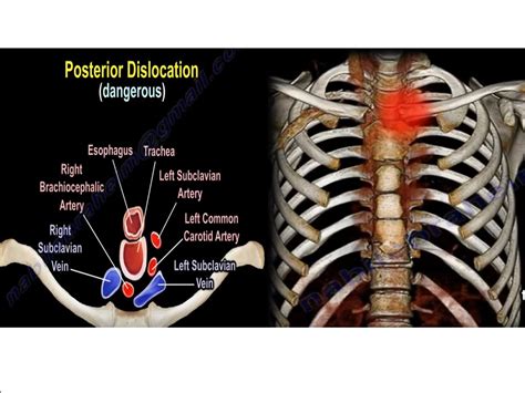 Posterior Dislocation Of Sternoclavicular Joint —