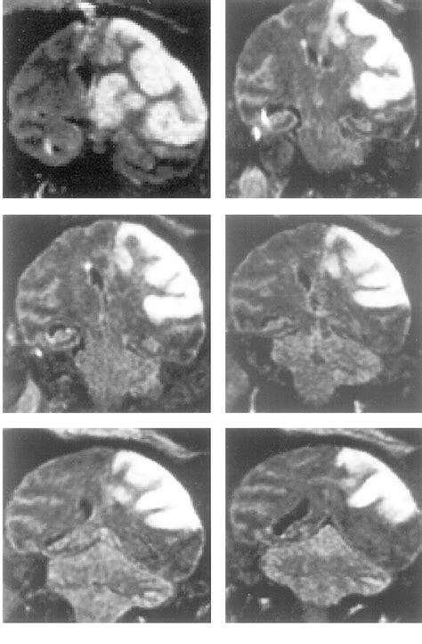 Figure 2 From A Modified Transorbital Baboon Model Of Reperfused Stroke Semantic Scholar